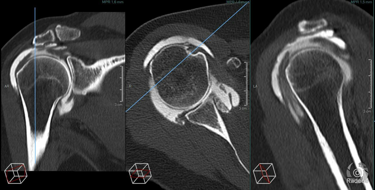 Rupture Transfixiante Du Tendon Supra épineux Maladie Professionnelle
