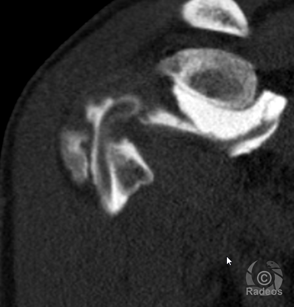 Déchirure du labrum glénoidien : SLAP lésion de type 3