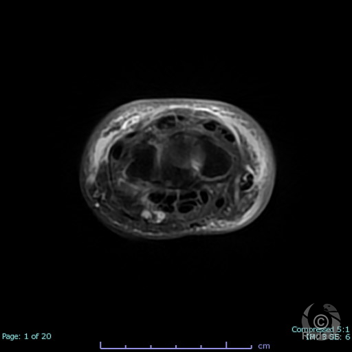 Aspect IRM d'un puffy hand syndrome