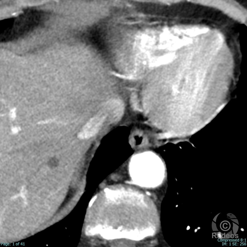 Hyperplasie bilatérale des surrénales