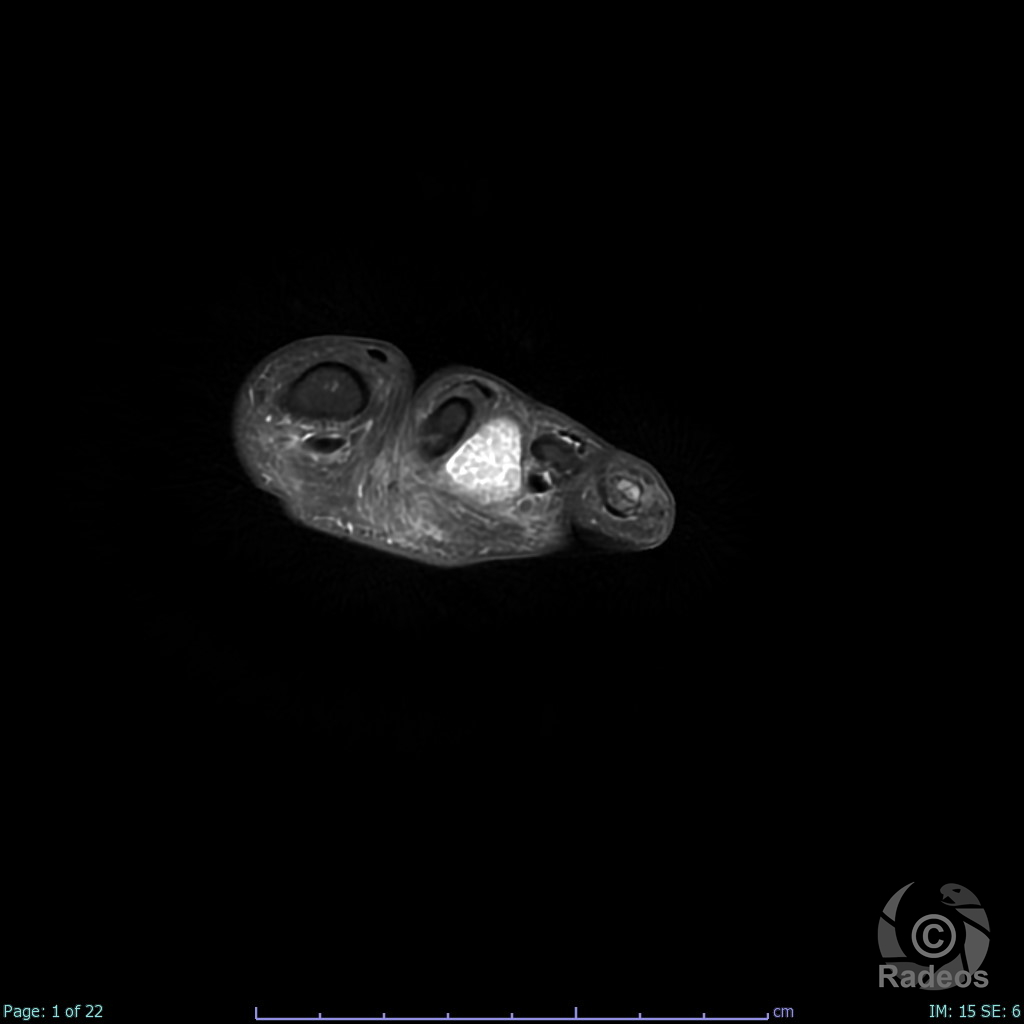 Bursite rhumatoïde à "grains de riz" inter-capito-métatarsienne