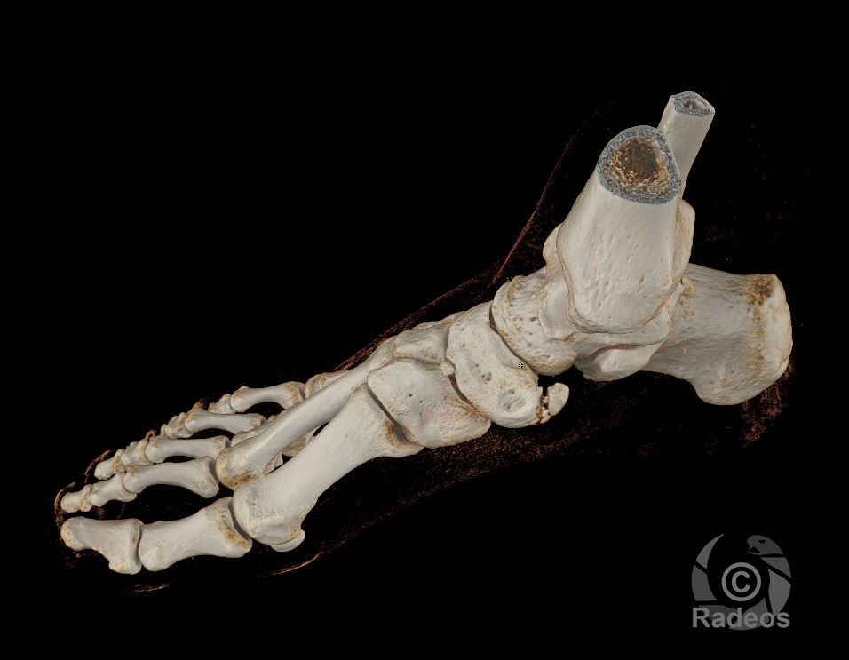 Syndrome de l'os naviculaire accessoire de type 2