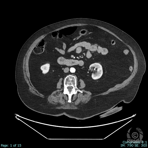 Aspect TDM typique d'un lipome colique droit