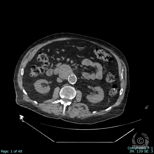 Anévrysme de l'aorte abdominale sous rénale traité par endoprothèse, avec endofuite de type 2b