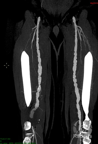 Ischémie aiguë de membre inférieur droit sur anévrysme poplité thrombosé dans un contexte de fibrodysplasie intimo-médiale évoluée
