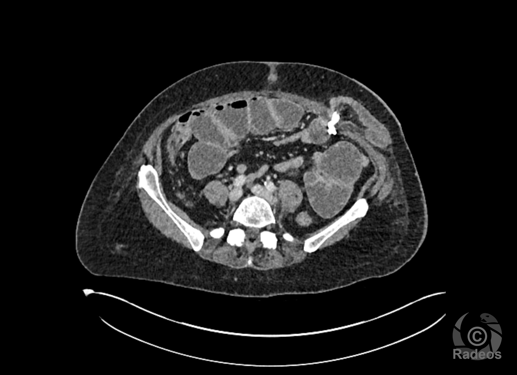 Diverticulite aiguë perforée, compliquée dans les suites d'un syndrome occlusif mécanique de l'intestin grêle au niveau de l'iléostomie.