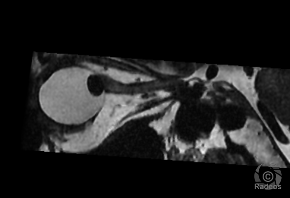 Luxation postérieure du cristallin gauche