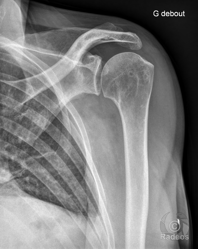 Rupture transfixiante complète du tendon du supraépineux avec rétraction médiale du moignon tendineux à l'aplomb de la tête humérale, de grade 2.
Rupture transfixiante complète du tendon infraépineux.
Minime enthésopathie à l'insertion du tendon sous-scapulaire.