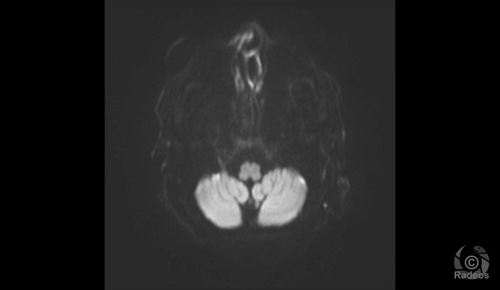 Encéphalopathie sur intoxication à la morphine/héroïne.