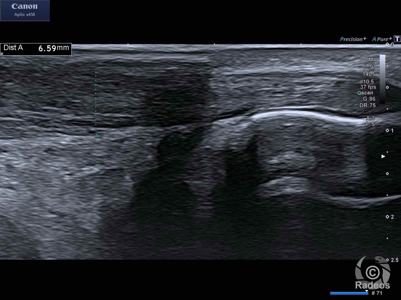 Rupture complète de la jonction-myo tendineuse du tendon Achilléen droit