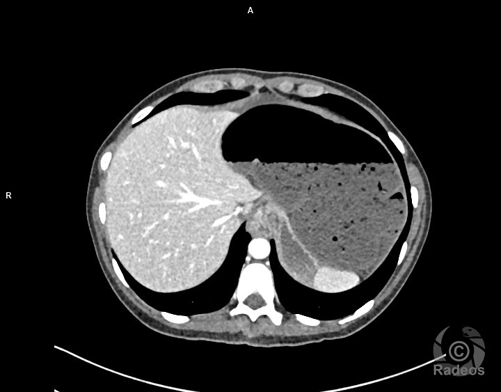 Volvulus du sigmoïde mésentérico-axial avec signe de souffrance digestive.