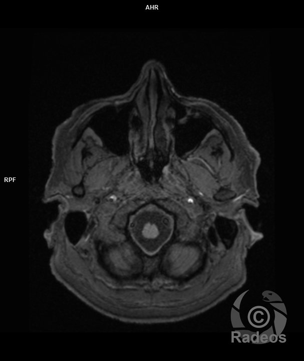 Névrite du nerf faciale. Aspect IRM