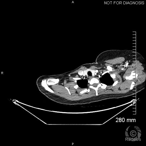 Ischémie aiguë de membre dupérieur droit sur anévrysme disséquant de l'artère sous-clavière compliquant un syndrome du défilé cervcio-brachial.