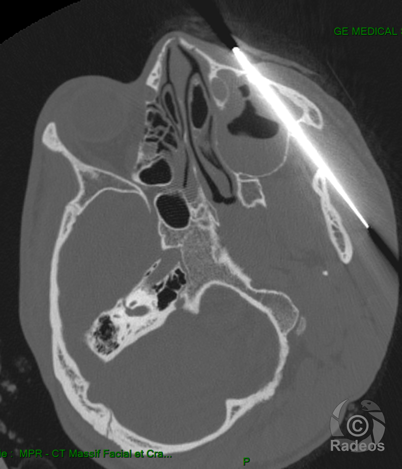 Corps étranger métallique (lame de couteau) traversant le sinus maxillaire gauche
