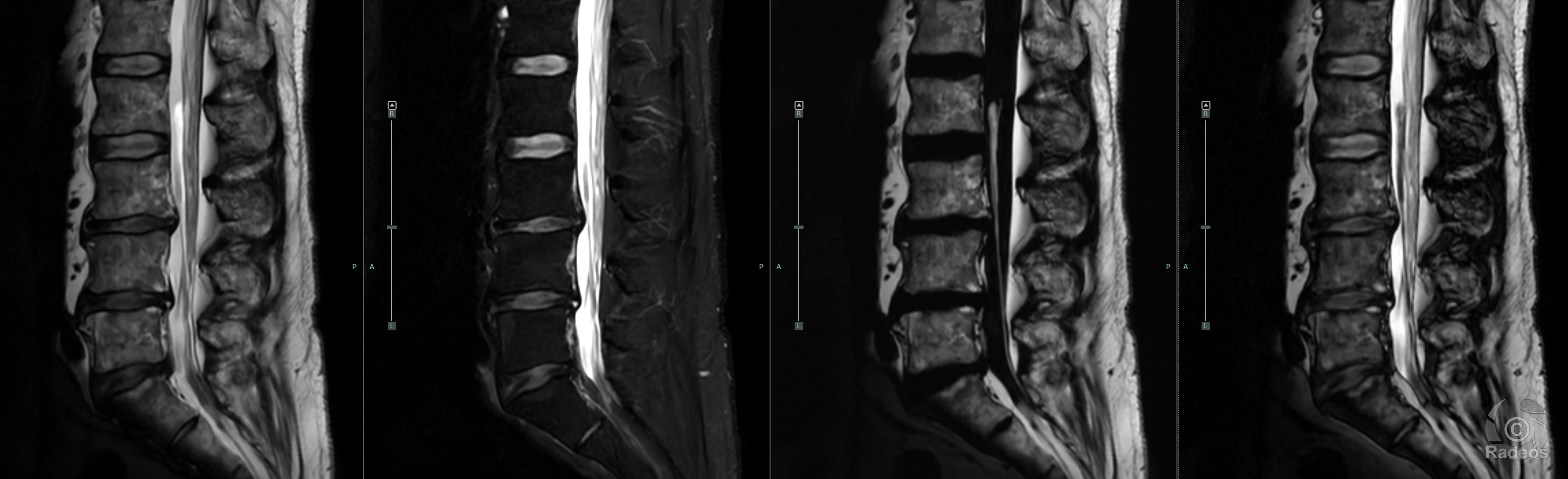 Aspect IRM typique d'un lipome du filum terminal