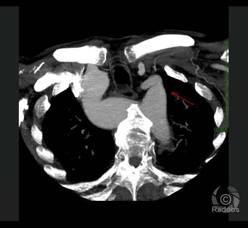 Découverte fortuite d'un arc aortique droit avec diverticule de Kommerell
