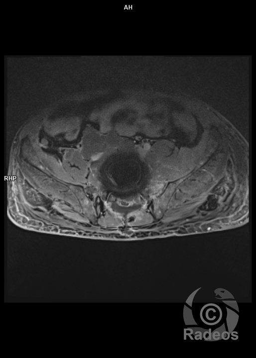 Plasmocytome du bassin avec envahissement loco-régional important, notamment épidural.