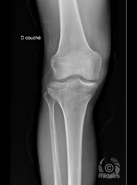 Fracture du plateau tibial externe droit de type Schatzker 2