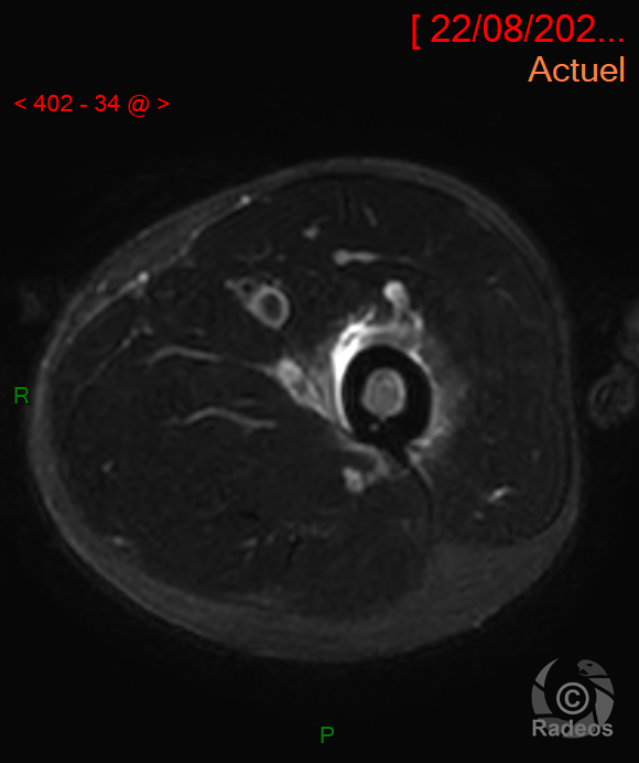 Crise vaso-occlusive avec infarctus osseux aigu sur drépanocytose.