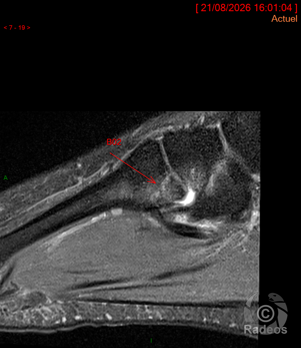 Fracture articulaire non déplacée de la base du deuxième métatarsien