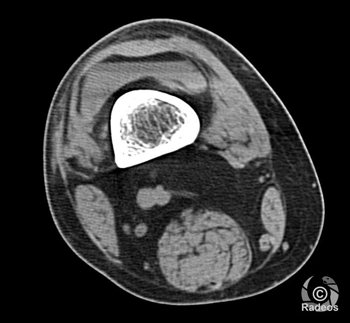 Lipohémarthrose. Fracture-enfoncement du plateau tibial externe et fracture de la métaphyse proximale de la fibula droite.